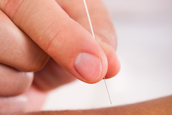 Acupuncture treatment