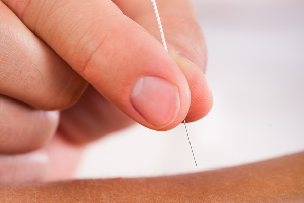 Acupuncture treatment