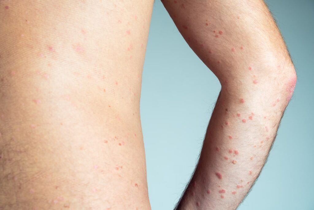 Skin Conditions converted